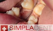 Классическая имплантация зуба