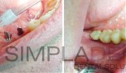 Классическая имплантация ROOTT жевательных зубов (октябрь 2014)