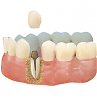 Протезирование зубов - штифты или культевые вкладки
