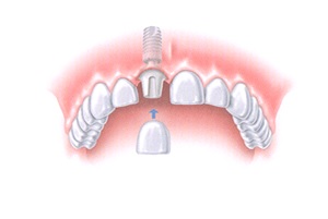 имплантация передних зубов