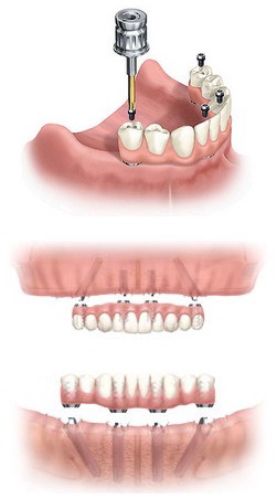 протезирование зубов на имплантах all-on-4