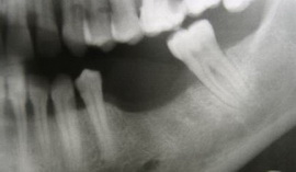 атрофия костной ткани после потери зуба