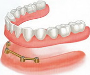 Зубные коронки на имплантах. Этапы установки и виды имплантов. Основные преимущества. установки.