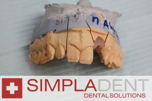 зуботехническая модель для изготовления коронки