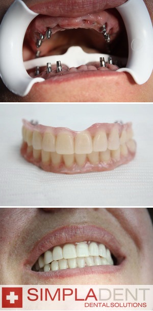 клинический случай базальной имплантации зубов
