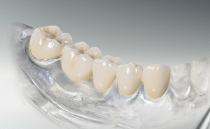 мостовидный зубной протез