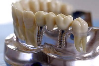 зубной мост на имплантах