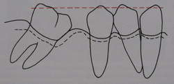 смещение зубов при отсутствии премоляров