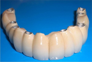 зубные коронки на имплантах