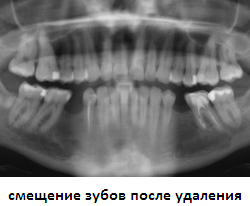 смещение зубов в сторону отсутствующих