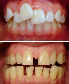 выравнивание передних зубов