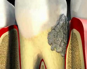 зубной камень - показание для профессиональной чистки