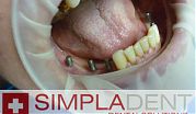 Базальная имплантация жевательных зубов