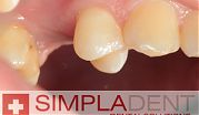 Классическая имплантация одного зуба