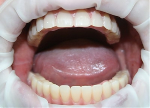 Подвижность зубов и пародонтит