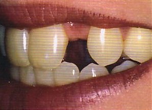 Отсутствие одного зуба