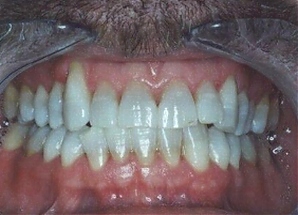Проблема 13: Тетрациклиновые зубы
