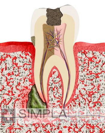 киста и гранулема корня зуба