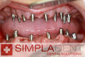 пример базальной имплантации зубов
