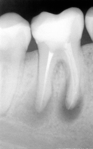 диагностика кисты зуба