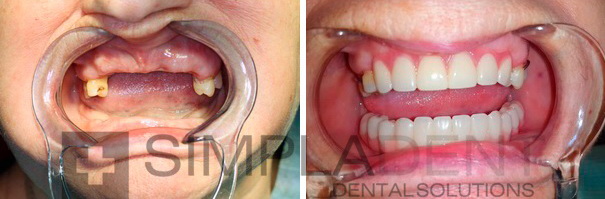 имплантация зубов с моментальной нагрузкой фото