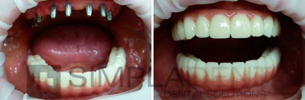 имплантация зубов с моментальной нагрузкой фото