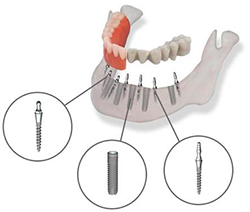 комбинированная имплантация зубов