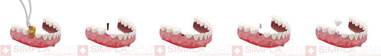 этапы имплантации зуба