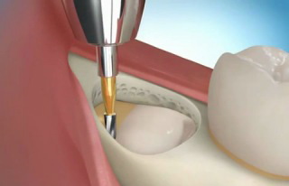 процесс удаления ретинированного дистопированного зуба