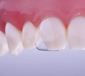 Как укрепить зубы, если они разрушаются