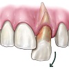Аутотрансплантация зубов