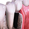 Отторжение импланта зуба: симптомы и признаки