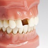 Потеря переднего зуба - как вернуть целостность зубного ряда