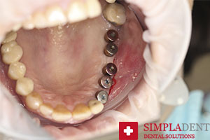 Комплексная имплантация 1 челюсти снимок до