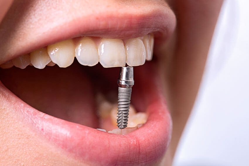 Как ставят имплантанты зубов