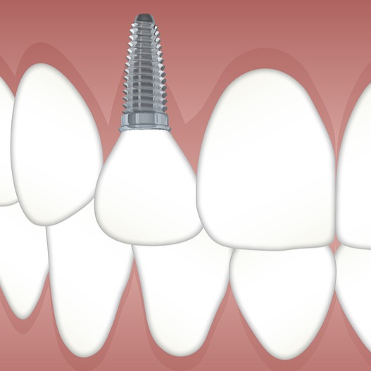 Импланты Дентиум (Dentium): виды корейских имплантов, показания, преимущества