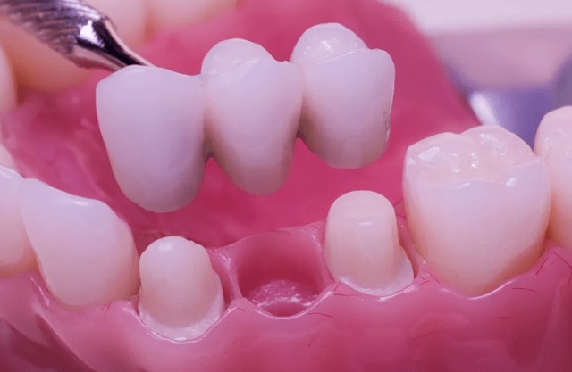 Современные методы протезирования зубов