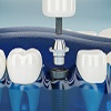 Акции на имплантацию зубов в Москве