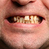 Гнилые зубы - удалять или нет?