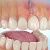 Имплантация зубов сроки лечения