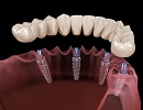 Имплантация зубов при иммунных заболеваниях