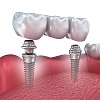 Имплантация 3 зубов