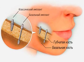 имплантация при полном отсутствии зубов