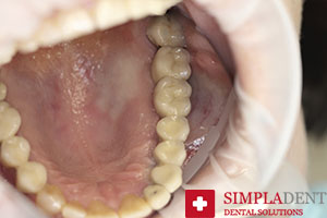 Комплексная имплантация 1 челюсти снимок после