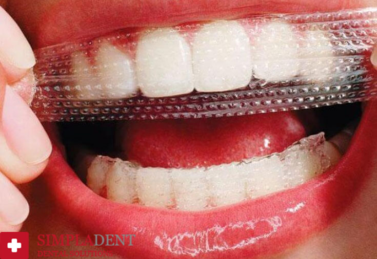 Технология восстановления эмали зубов