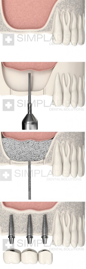 синус-лифтинг при миплантации зубов