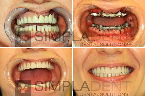 фото до и после имплантации зубов