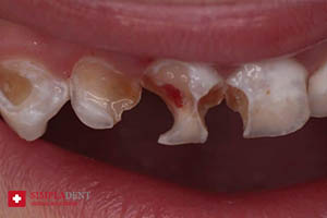 проблема гнилых зубов, как лечить