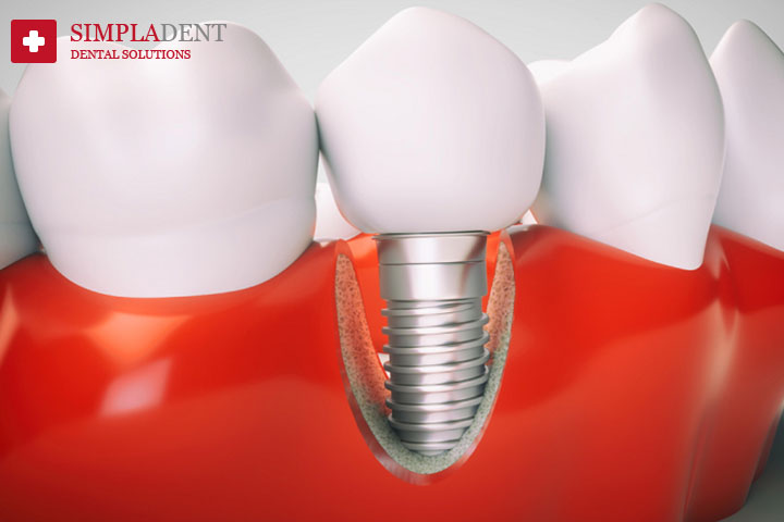 Отторжение импланта зуба
