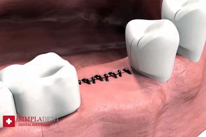 причины отторжения зубных имплантов